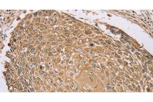 Immunohistochemistry of paraffin-embedded Human lung cancer tissue using RNF148 Polyclonal Antibody at dilution 1:45 (RNF148 antibody)