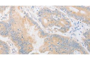 Immunohistochemistry of paraffin-embedded Human colon cancer using CD24 Polyclonal Antibody at dilution of 1:40 (CD24 antibody)