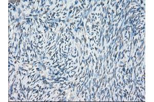 Immunohistochemical staining of paraffin-embedded Adenocarcinoma of breast tissue using anti-POR mouse monoclonal antibody. (POR antibody)