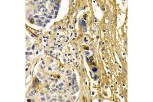 Immunohistochemistry of paraffin-embedded human liver cancer using CFH antibody at dilution of 1:200 (400x lens).