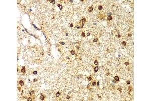 Immunohistochemistry of paraffin-embedded Human brain cancer using SMAD9 Polyclonal Antibody at dilution of 1:100 (40x lens).