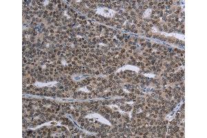 Immunohistochemistry of Human thyroid cancer using MAGEC1 Polyclonal Antibody at dilution of 1:30