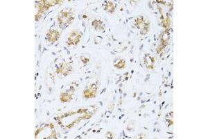 Immunohistochemistry of paraffin-embedded human breast cancer using ETV1 antibody (ABIN6291698) at dilution of 1:100 (40x lens).