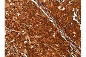 The image on the left is immunohistochemistry of paraffin-embedded Human gastric cancer tissue using ABIN7190469(DHH Antibody) at dilution 1/25, on the right is treated with synthetic peptide. (desert Hedgehog antibody)