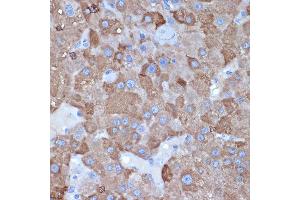 Immunohistochemistry of paraffin-embedded human liver cancer using L1 Rabbit mAb (ABIN7265535) at dilution of 1:100 (40x lens).