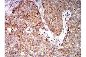 Immunohistochemical analysis of paraffin-embedded bladder cancer tissues using EIF5 mouse mAb with DAB staining. (EIF5 antibody  (AA 1-300))