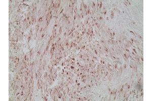 Immunohistochemistry analysis of human melanoma skin tissue using Melanoma marker (human) mAb (HMB45), (ABIN7211713) at a dilution of 1:20. (Melanoma Marker antibody)