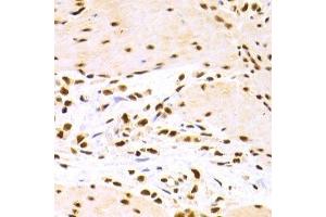 Immunohistochemistry of paraffin-embedded human gastric cancer using DDB1 Antibody. (DDB1 antibody)