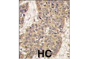 Formalin-fixed and paraffin-embedded human hepatocarcinoma tissue reacted with CASP6 antibody (C-term), which was peroxidase-conjugated to the secondary antibody, followed by DAB staining. (Caspase 6 antibody  (C-Term))