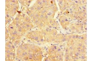 Immunohistochemistry of paraffin-embedded human liver cancer using ABIN7175166 at dilution of 1:100 (UGP2 antibody  (AA 1-497))