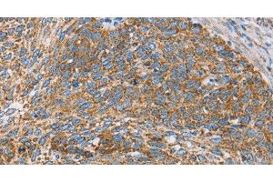 Immunohistochemistry of paraffin-embedded Human cervical cancer tissue using CENPO Polyclonal Antibody at dilution 1:40
