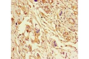 Immunohistochemistry of paraffin-embedded human pancreatic cancer using ABIN7151998 at dilution of 1:100 (ERLIN2 antibody  (AA 25-206))