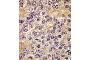 Formalin-fixed and paraffin-embedded human prostata carcinoma tissue reacted with PLAU antibody (C-term ), which was peroxidase-conjugated to the secondary antibody, followed by DAB staining. (PLAU antibody  (C-Term))