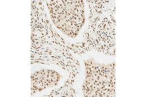 C staining HS in human lung adenocarcinoma tissue sections by Immunohistochemistry (IHC-P - paraformaldehyde-fixed, paraffin-embedded sections). (HSPA7 antibody  (AA 169-196))