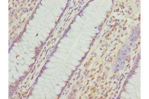 Immunohistochemistry of paraffin-embedded human colon cancer using ABIN7156409 at dilution of 1:100 (Integrator Complex Subunit 14 (INTS14) (AA 231-518) antibody)