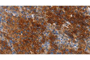 Immunohistochemistry of paraffin-embedded Human liver cancer tissue using CA9 Polyclonal Antibody at dilution 1:50 (CA9 antibody)