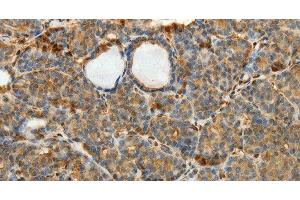 Immunohistochemistry of paraffin-embedded Human thyroid cancer using SULT1E1 Polyclonal Antibody at dilution of 1:30 (SULT1E1 antibody)
