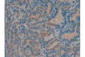 Detection of MUC5AC in Human Thyroid cancer Tissue using Polyclonal Antibody to Mucin 5 Subtype AC (MUC5AC) (MUC5AC antibody)