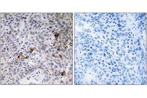 Immunohistochemistry analysis of paraffin-embedded human lung carcinoma tissue, using RAB11FIP3 Antibody. (RAB11FIP3 antibody  (AA 569-618))