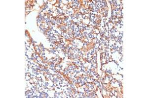 Immunohistochemistry of paraffin-embedded human appendix using Phospho-Vimentin-S39 antibody (ABIN7271327) at dilution of 1:100 (40x lens). (Vimentin antibody  (pSer39))
