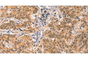 Immunohistochemistry of paraffin-embedded Human gastric cancer using EIF4G1 Polyclonal Antibody at dilution of 1:30 (EIF4G1 antibody)