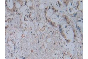 DAB staining on IHC-P;;Samples: Human Pancreatic cancer Tissue (CCL2 antibody  (AA 24-99))
