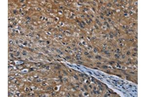 The image on the left is immunohistochemistry of paraffin-embedded Human esophagus cancer tissue using ABIN7190993(HOXC8 Antibody) at dilution 1/20, on the right is treated with synthetic peptide.