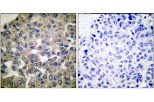 Immunohistochemistry analysis of paraffin-embedded human breast carcinoma tissue, using PLCG1 (Ab-771) Antibody. (Phospholipase C gamma 1 antibody  (AA 736-785))