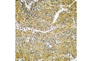 Immunohistochemical analysis of SVOP staining in human liver cancer formalin fixed paraffin embedded tissue section.
