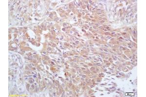 Formalin-fixed and paraffin embedded human lung carcinoma labeled with Anti-Phospho-cdc25A (Thr506) Polyclonal Antibody, Unconjugated (ABIN684028) at 1:200 followed by conjugation to the secondary antibody and DAB staining (CDC25A antibody  (pThr507))