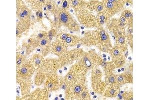 Immunohistochemistry of paraffin-embedded Human liver damage using KIF1B Polyclonal Antibody at dilution of 1:100 (40x lens).