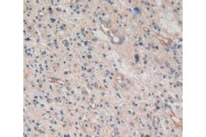 Detection of AREG in Human Glioma Tissue using Monoclonal Antibody to Amphiregulin (AREG) (Amphiregulin antibody  (AA 20-100))