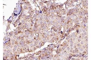 ABIN6267668 at 1/100 staining Human breast cancer tissue by IHC-P. (DPYSL2 antibody  (pThr514))