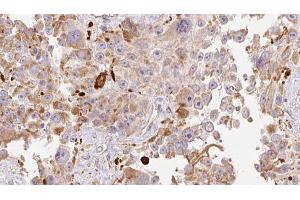 ABIN6274013 at 1/100 staining Human Melanoma tissue by IHC-P. (HAPLN1 antibody  (N-Term))