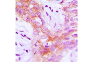 Immunohistochemical analysis of IGF1 Receptor (pY1161) staining in human breast cancer formalin fixed paraffin embedded tissue section. (IGF1R antibody  (C-Term, pTyr1161))
