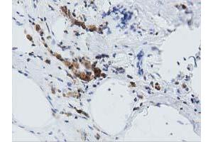 Immunohistochemical staining of paraffin-embedded Carcinoma of Human lung tissue using anti-ARHGAP25 mouse monoclonal antibody. (ARHGAP25 antibody)