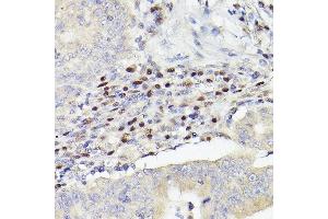 Immunohistochemistry of paraffin-embedded human colon carcinoma using MEF2A+MEF2C Rabbit mAb (ABIN1679049, ABIN1679050, ABIN7101495 and ABIN7101496) at dilution of 1:100 (40x lens). (MEF2A+MEF2C antibody)