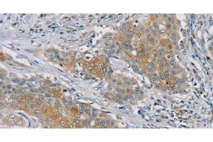 Immunohistochemistry of paraffin-embedded Human ovarian cancer tissue using RASA2 Polyclonal Antibody at dilution 1:45 (RASA2 antibody)