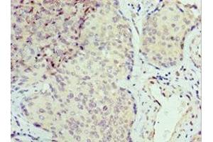 Immunohistochemistry of paraffin-embedded human cervical cancer using ABIN7168869 at dilution of 1:100 (Septin 6 antibody  (AA 350-434))