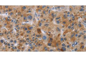 Immunohistochemistry of paraffin-embedded Human liver cancer tissue using IAPP Polyclonal Antibody at dilution 1:40 (Amylin/DAP antibody)