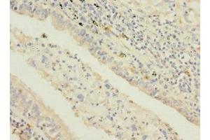 Immunohistochemistry of paraffin-embedded human lung cancer using ABIN7169694 at dilution of 1:100 (STAM2 antibody  (AA 376-525))