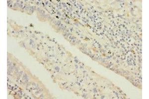 Immunohistochemistry of paraffin-embedded human lung cancer using ABIN7169694 at dilution of 1:100