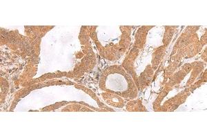 Immunohistochemistry of paraffin-embedded Human thyroid cancer tissue using ETV3 Polyclonal Antibody at dilution of 1:25(x200) (ETV3 antibody)