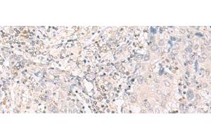 Immunohistochemistry of paraffin-embedded Human cervical cancer tissue using IL12B Polyclonal Antibody at dilution of 1:35(x200) (IL12B antibody)
