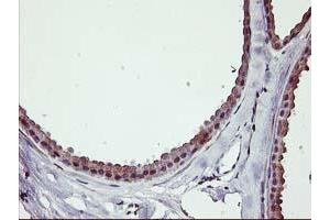 Immunohistochemical staining of paraffin-embedded Human breast tissue using anti-ERBB2 mouse monoclonal antibody. (ErbB2/Her2 antibody  (AA 676-1255))