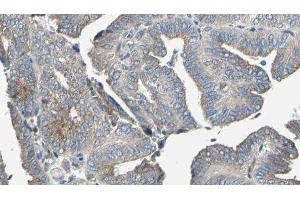 ABIN6277082 at 1/100 staining Human cervical cancer tissue by IHC-P. (TRKA antibody  (C-Term))