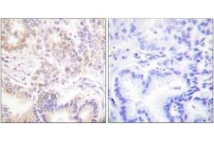Immunohistochemistry analysis of paraffin-embedded human lung carcinoma tissue, using SENP5 Antibody. (SENP5 antibody  (AA 651-700))