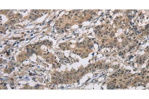 Immunohistochemistry of paraffin-embedded Human gastric cancer tissue using DSG2 Polyclonal Antibody at dilution 1:50 (Desmoglein 2 antibody)