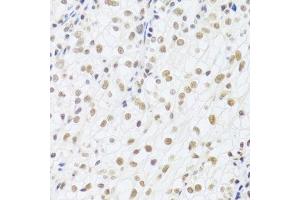 Immunohistochemistry of paraffin-embedded human kidney cancer using DDB1 Antibody. (DDB1 antibody)