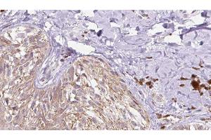 ABIN6279754 at 1/100 staining Human Melanoma tissue by IHC-P. (Reelin antibody  (N-Term))